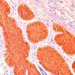 mohs-micrographic-surgery-1290x1290